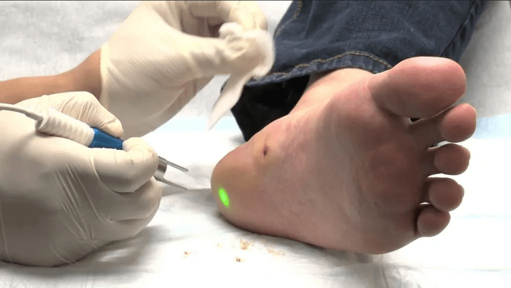 Plantar wart treatment