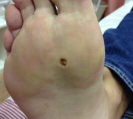 Ways to eliminate the wart in the sole of the legs