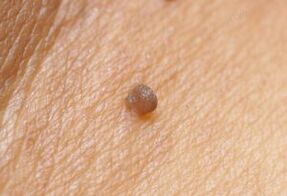 Papilloma clinical image