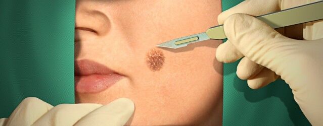 Papillomian surgical treatment