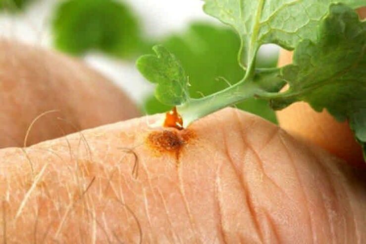 How to eliminate papillomas with popular remedies