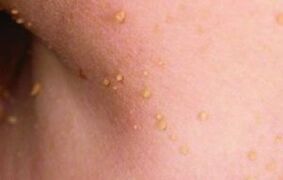 The reasons for the appearance of papillomas in the body