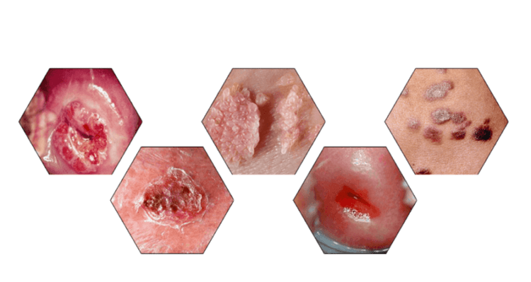 Why are papillomas dangerous