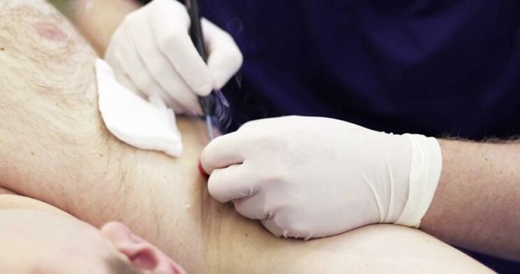 Professional methods for removing papillomas on the human body.