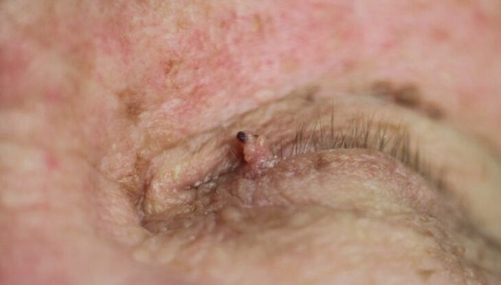 papilloma on the eyelid how to get rid of it