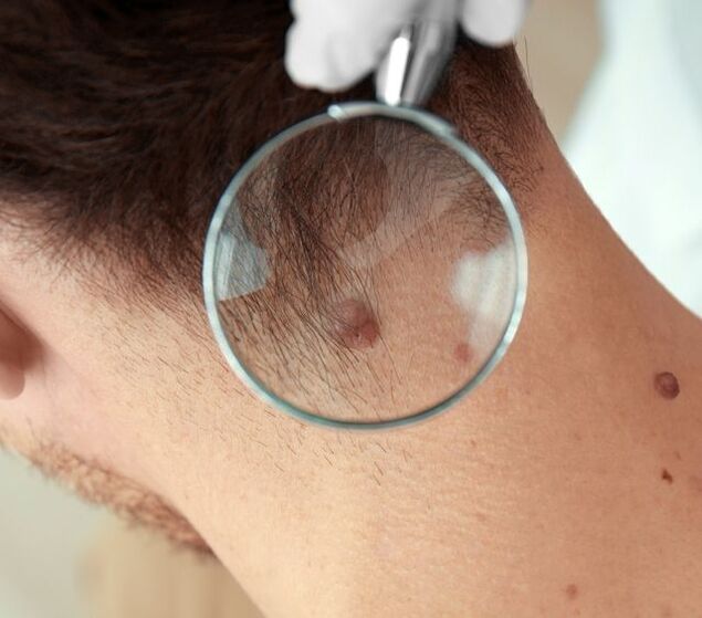 A doctor examines a papilloma on the neck.