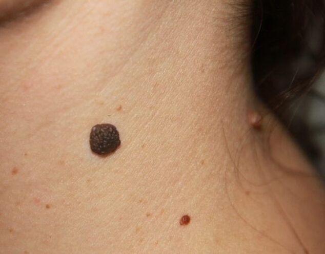 Flat papillomas on the neck.