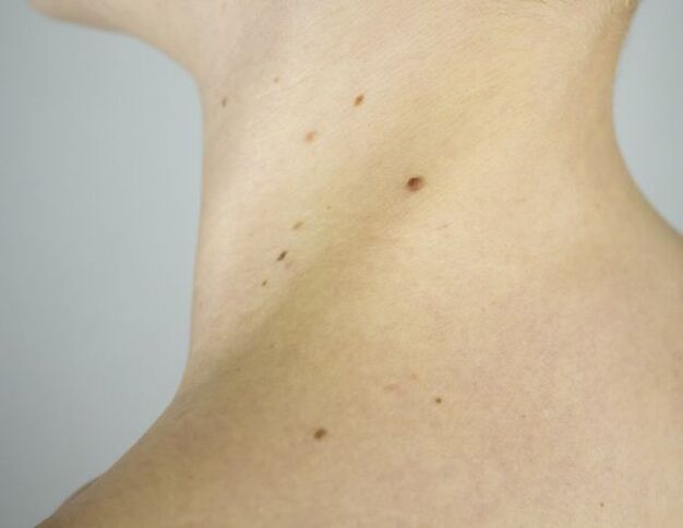 Papillomas on the neck of a girl.