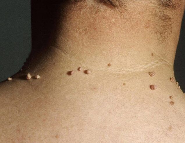 Papillomas on the neck of a man.
