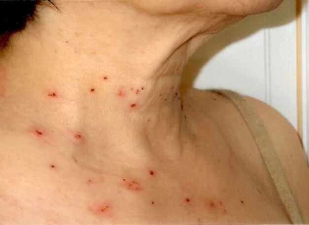 Results of treatment of papillomas on the neck.