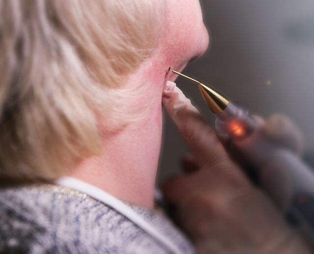 The process of removing papilloma on the neck of a woman.
