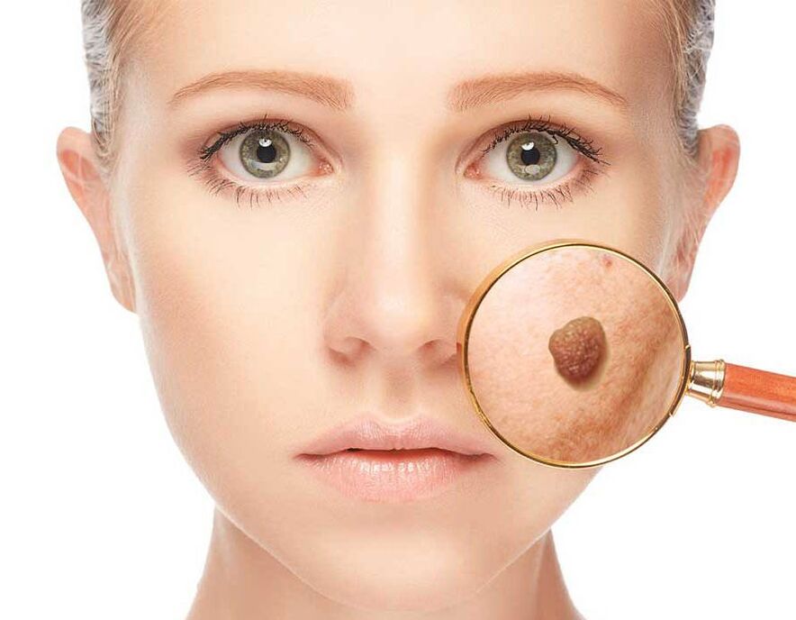 Papilloma on the face