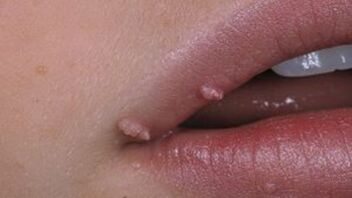 Papillomas on the lips.
