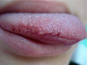 Papillomas on the tongue
