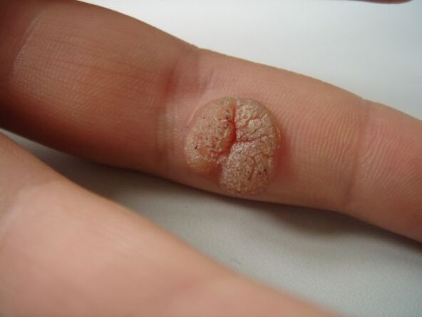 Complication of self-removal of papilloma.