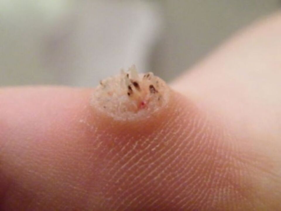 papilloma on the skin